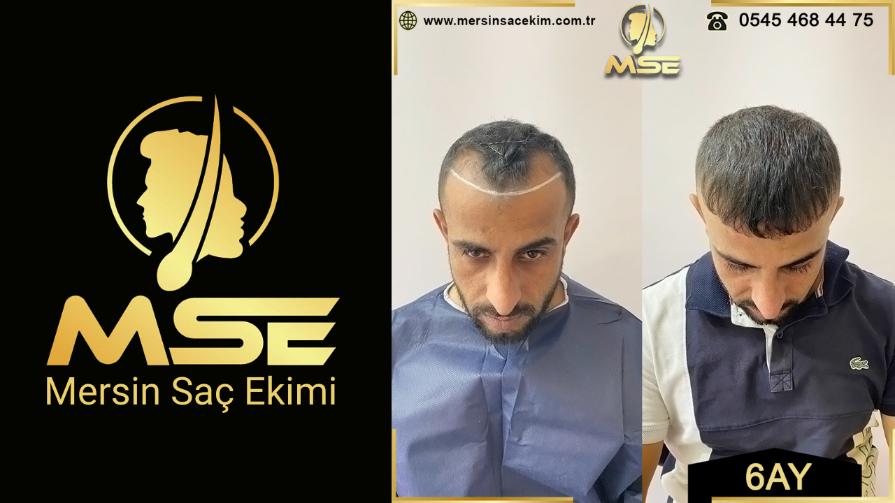 Mersin Saç Ekimi